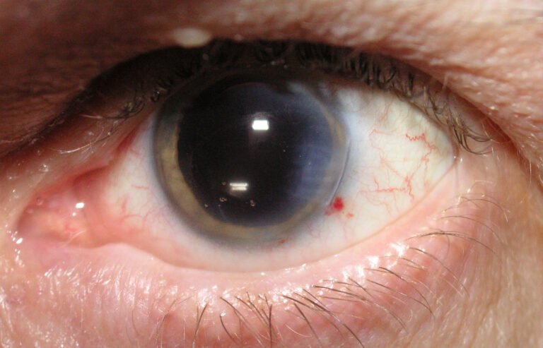 Understanding Cataract Surgery
