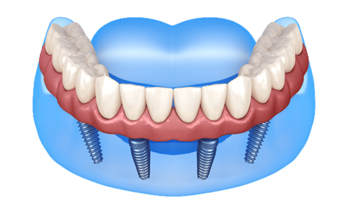 FAQs About All-On-6 Restorations
