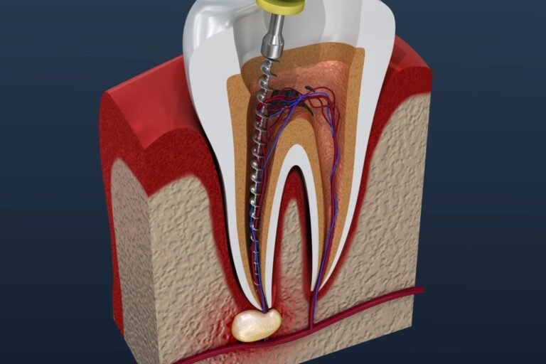 Myths and Facts About Root Canals