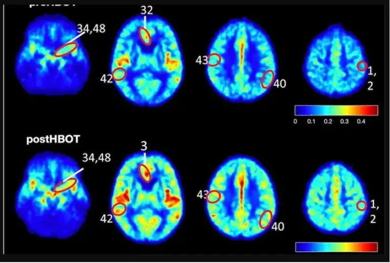 Neuroradiology's Role in Understanding Brain Plasticity