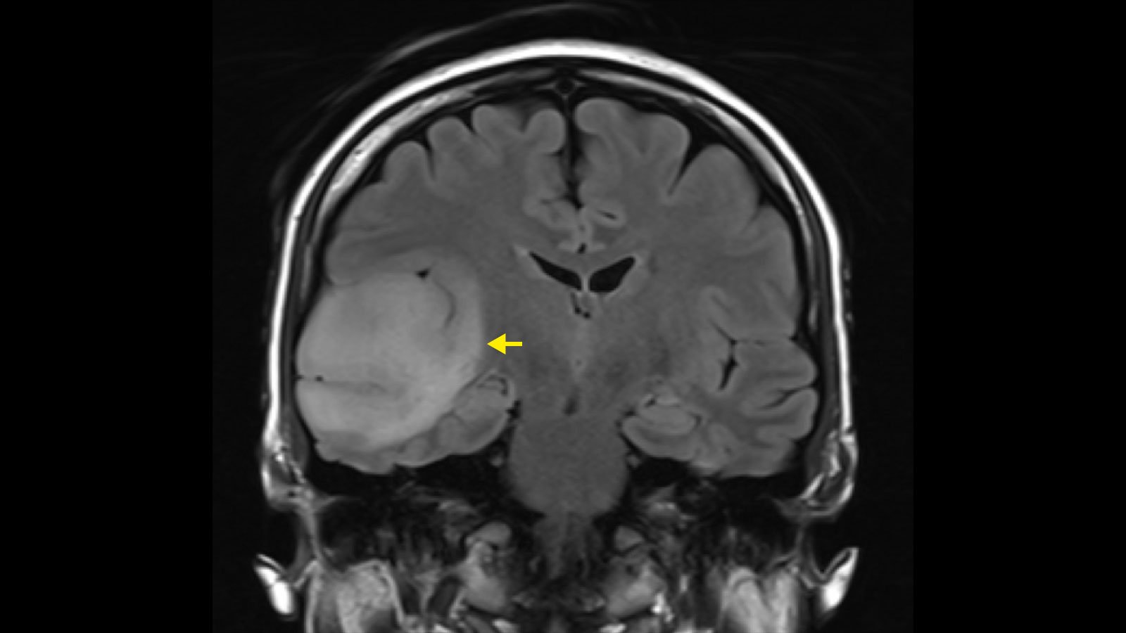 Questions to Ask Your Neurosurgeon Before Brain Tumor Surgery