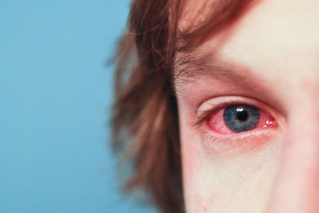 Tips for Managing Allergies