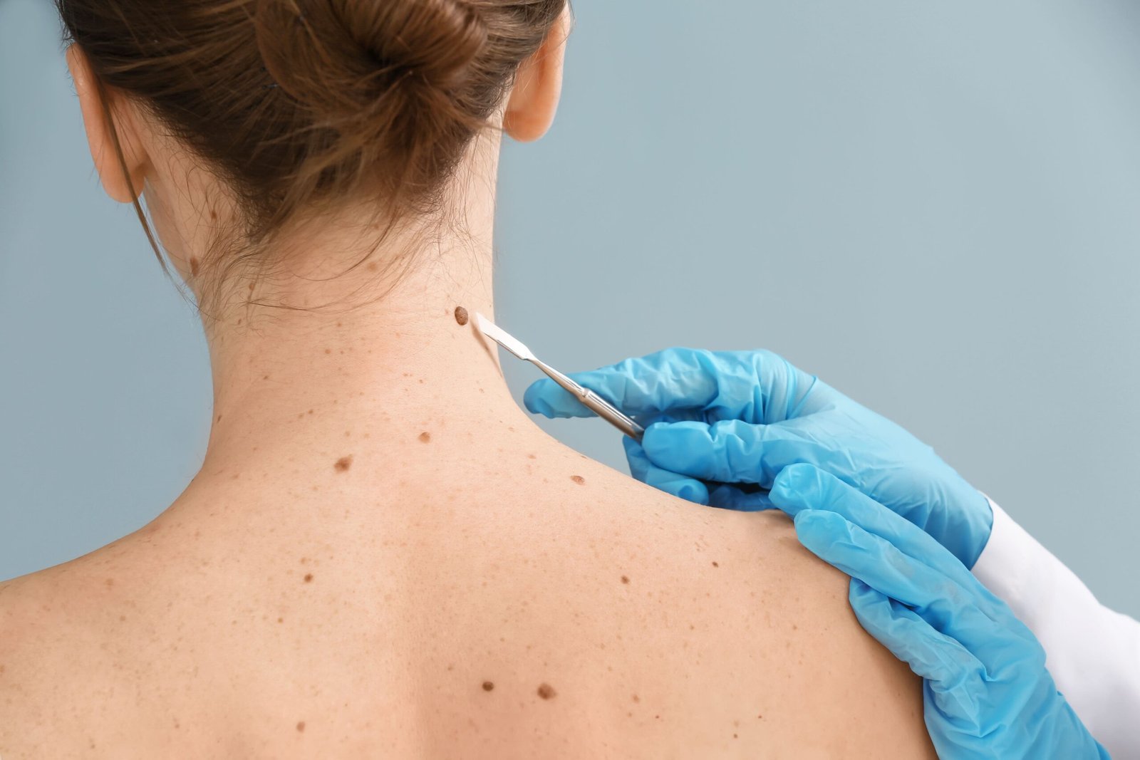 Understanding Skin Cancer and Its Causes