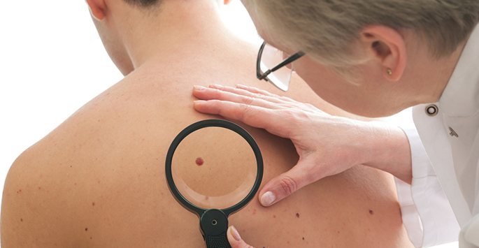 Understanding the Stages of Skin Cancer and Their Treatments