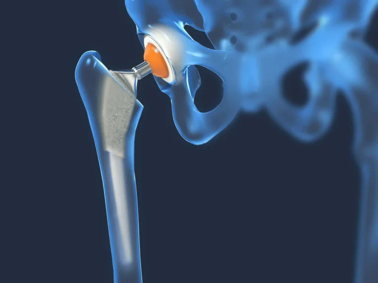 What To Expect Before and After a Hip Replacement Surgery
