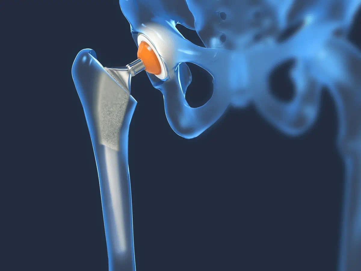 What To Expect Before and After a Hip Replacement Surgery