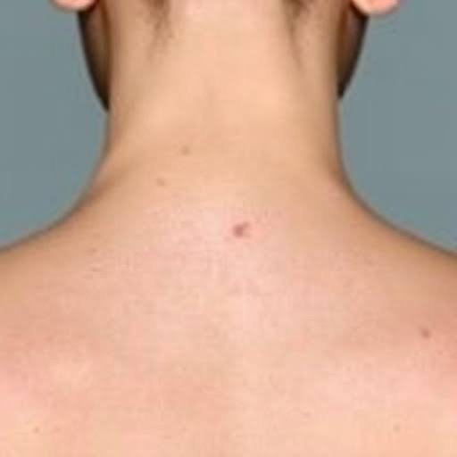 Exploring Skin Cancer Types and Treatments