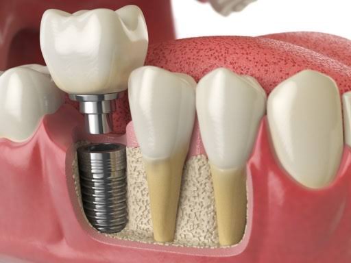 FAQs About Dental Implants
