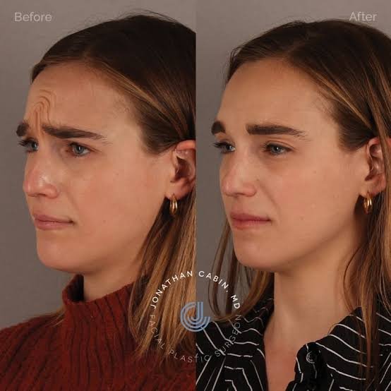 How Botox Can Enhance Your Natural Features