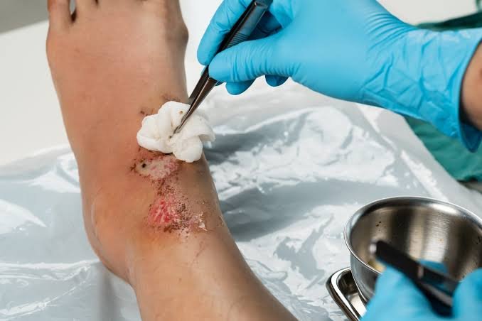 The Link Between Proper Wound Care and Infection Prevention