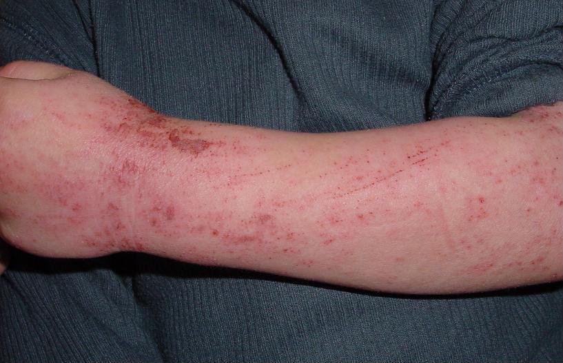 Understanding Triggers of Skin Allergies