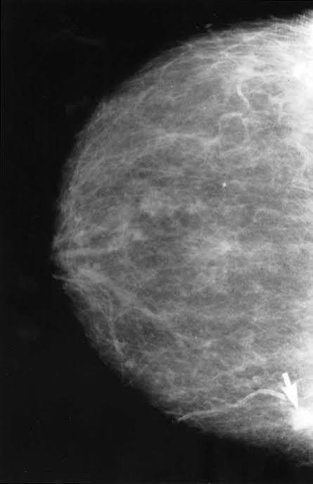 What Are the Possible Results of a Mammogram?
