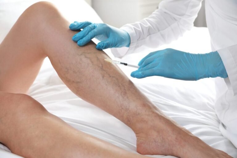 What To Know About Varithena as a Varicose Vein Treatment
