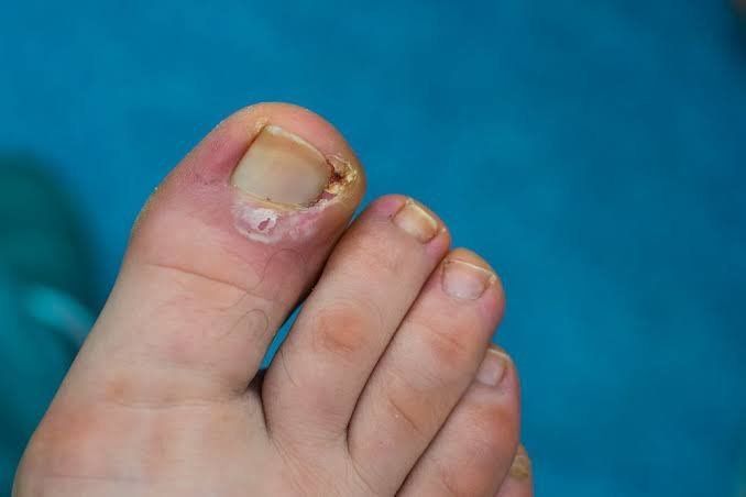 How You Can Help Prevent Ingrown Toenails
