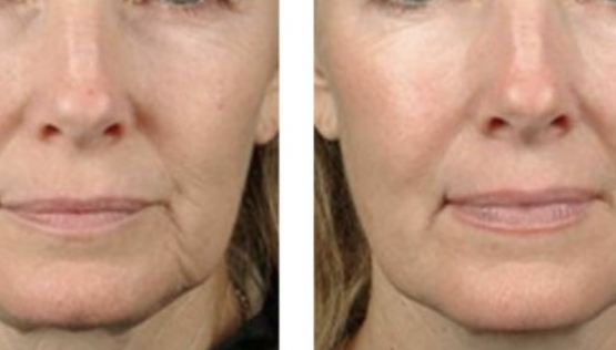 What to Expect Before, During, and After PRP Injection Treatment